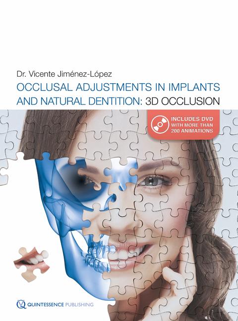 Occlusal Adjustments in Implants and Natural Dentition: 3D Occlusion