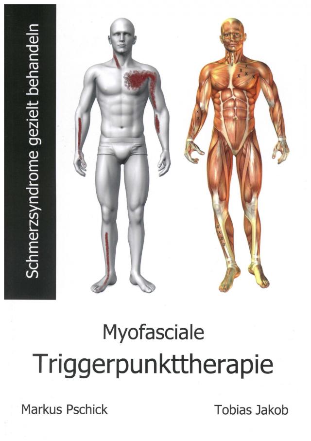 Myofasciale Triggerpunkttherapie