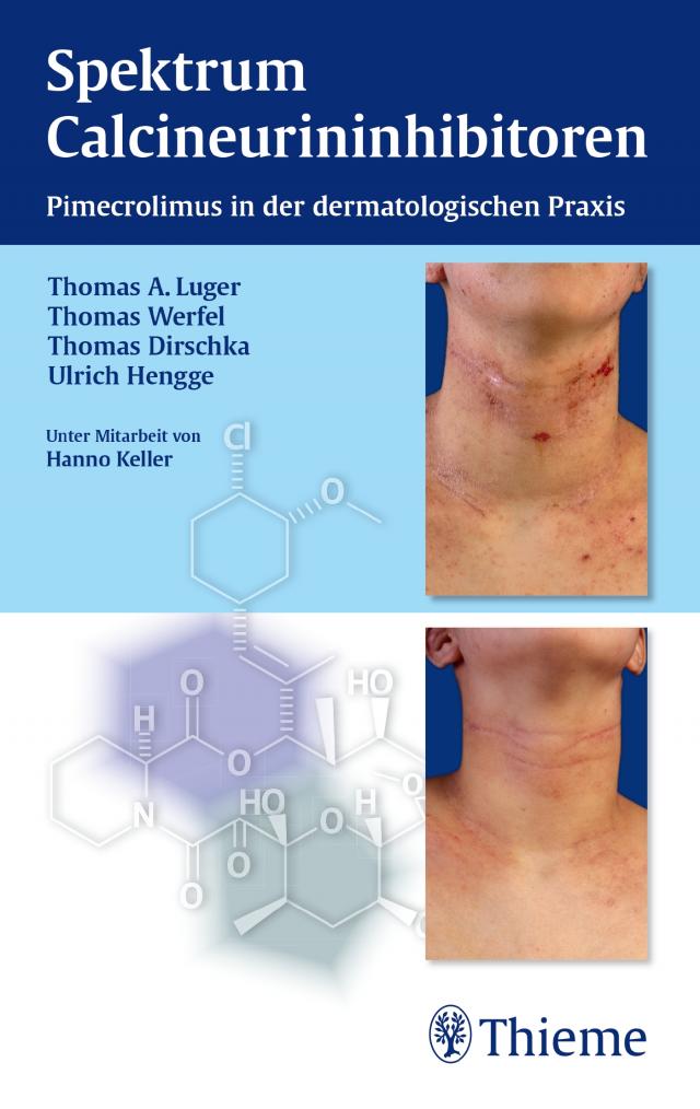 Spektrum Calcineurininhibitoren: Pimecrolimus in der dermatologischen Praxis