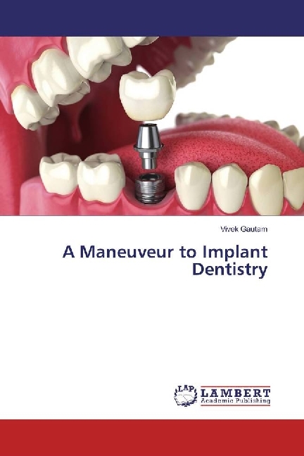 A Maneuveur to Implant Dentistry
