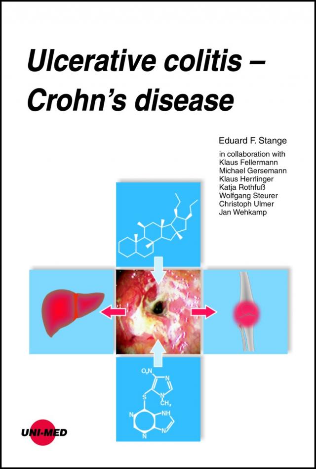 Ulcerative colitis - Crohn’s disease