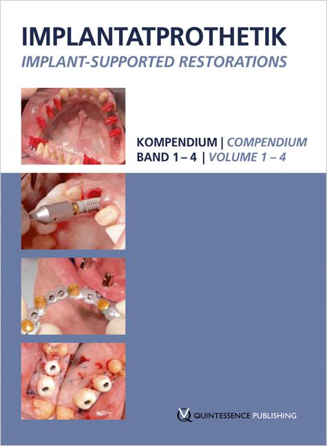 Implantatprothetik. DVD-Kompendium