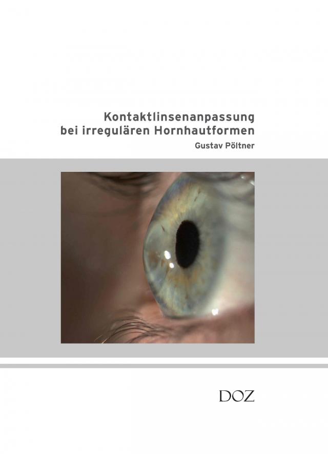 Kontaktlinsenanpassung bei irregulären Hornhautformen