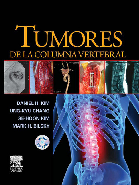 Tumores de la columna vertebral