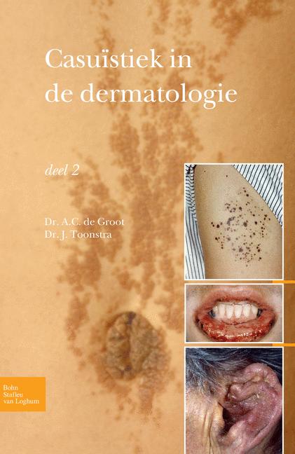 Casuïstiek in de dermatologie - deel 2